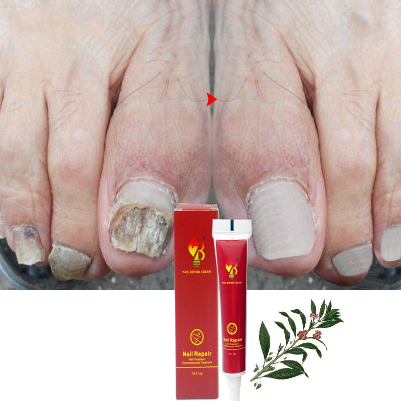 Best Fungus Nail Treatment Cream Onychomycosis Paronychia Anti Fungal Nail Infection Fights Bacteria And Fungus Naturally